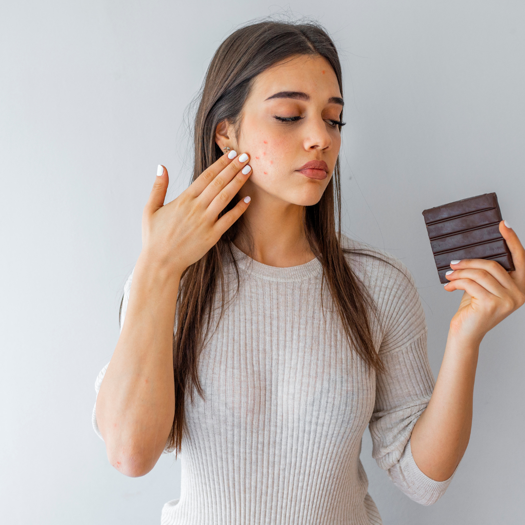 Chocolate e acne: Mito ou verdade? Desvendando os Fatos